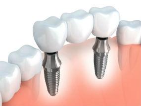 Dental Implants | Holland Family Dental | Owatonna, MN Dentist