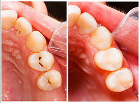 Composite Fillings | Holland Family Dental | Owatonna Dentist
